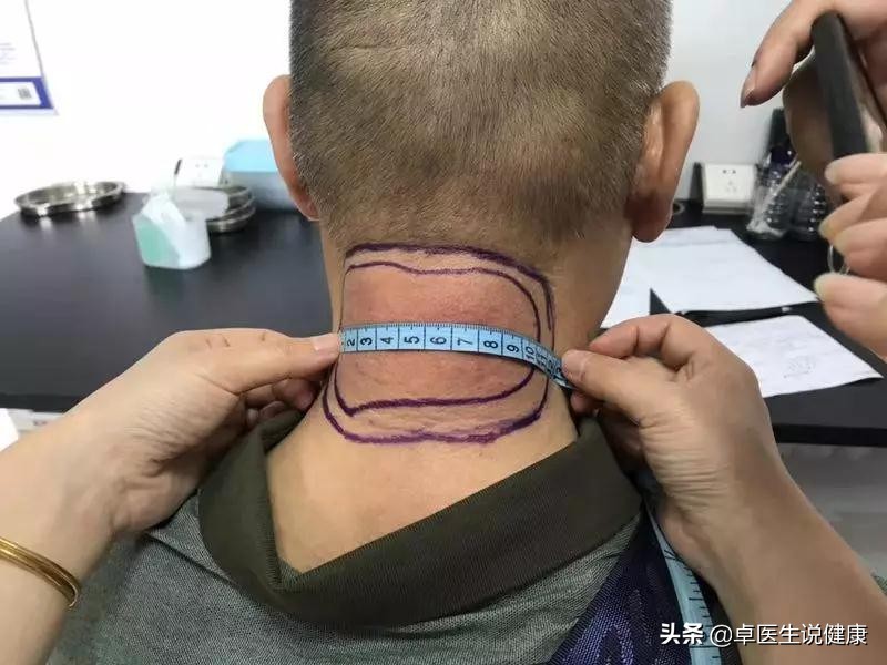 中医颊针案例分享:颈部包块20年,通过中医颊针疗法解决问题