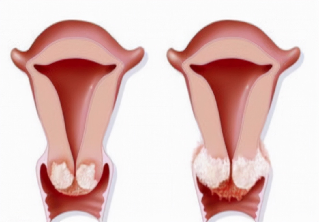 女性腿疼是宫颈癌的早期预兆吗,女性双腿疼痛查出宫颈癌