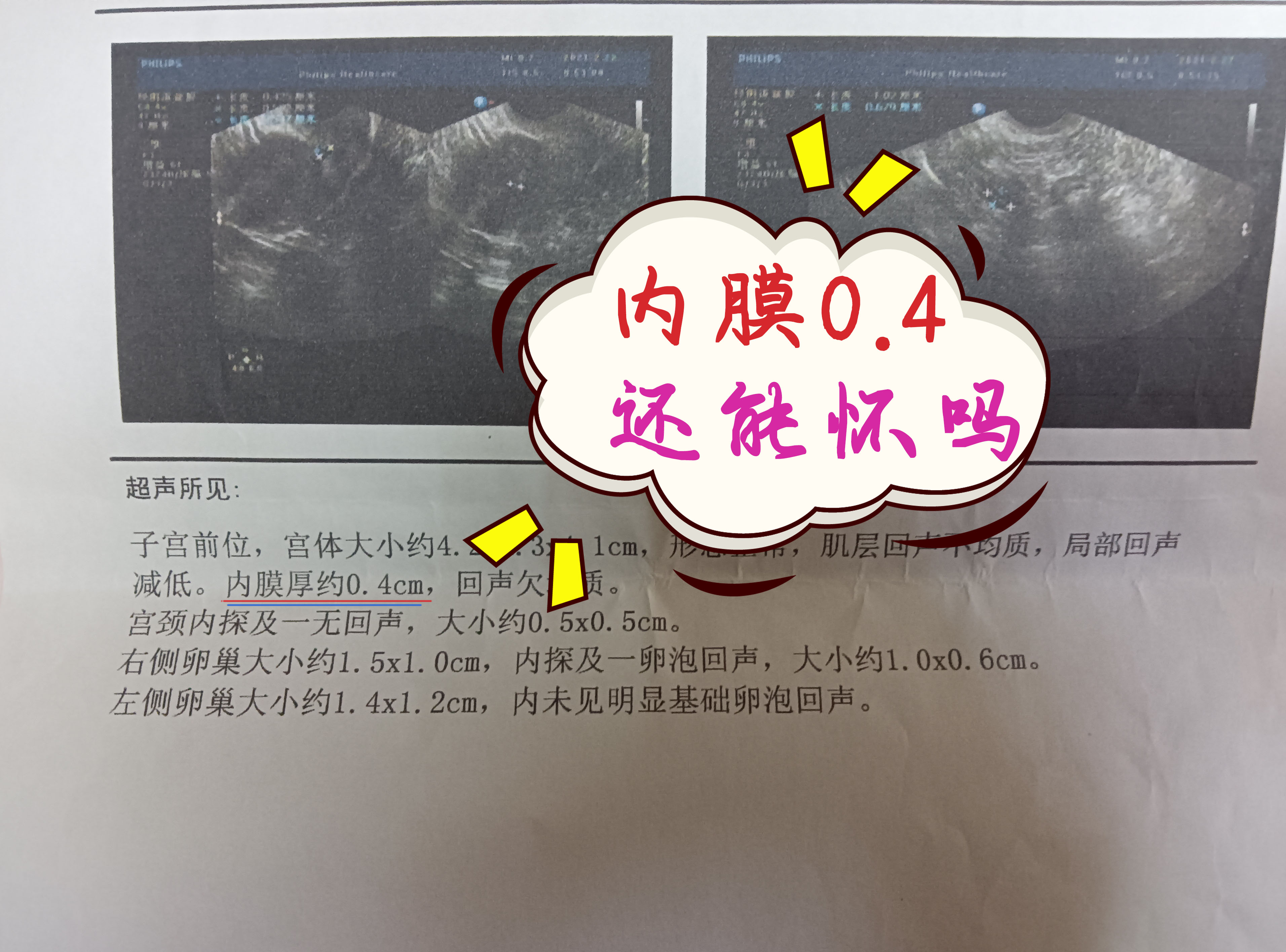 子宫内膜薄产后会内膜厚吗,人流后多年发现子宫内膜厚薄不均