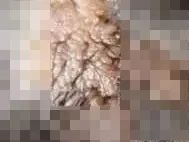 6岁儿童丝状疣怎么治疗,小孩子得寻常疣是什么原因造成的