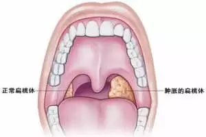 扁桃体发炎与扁桃体癌的区别,扁桃体瘤和扁桃体癌的区别