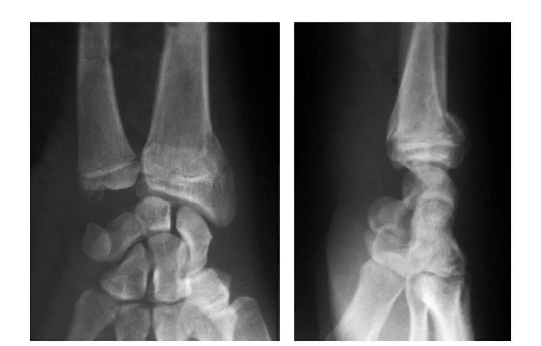 青少年肘部损伤最常见的是,肘部桡神经损伤的临床表现