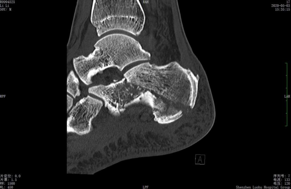 左股骨粗隆间粉碎性骨折微创手术,跟骨粉碎性骨折微创手术最快多久