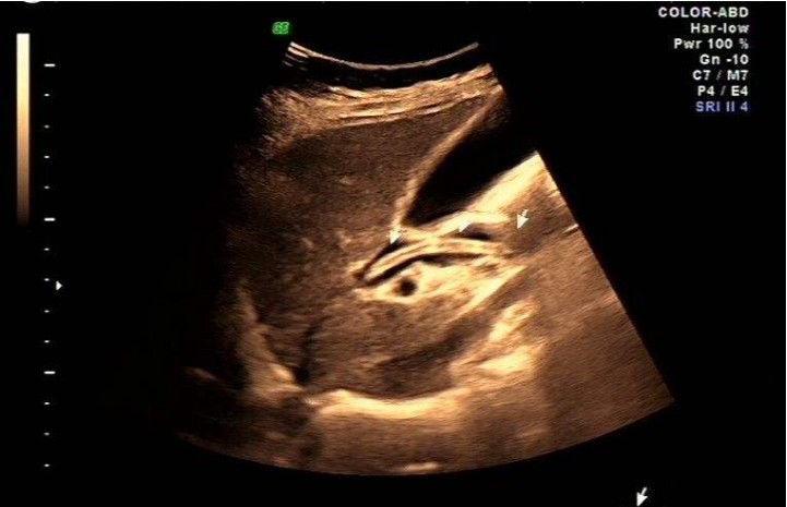 7岁男童肚子有蛔虫的表现,7岁男童肚子里蛔虫