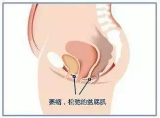 笑得尿失禁怎么办,笑会流尿出来是什么原因