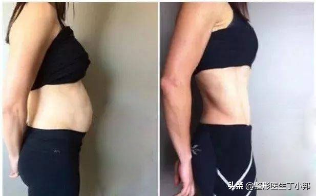 刚生完宝宝肚子有一块硬硬的,生了宝宝后肚子松弛怎么恢复