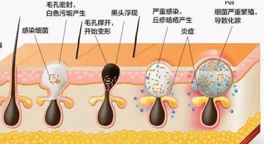 黑头拯救方法无成本,有黑头了该怎么有效去黑头