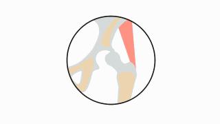 孩子o型腿会怎么样,老人o型腿怎样治疗最好