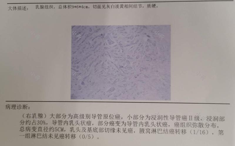 乳腺癌病例报告解读,肿瘤医生笔记乳腺癌篇转载