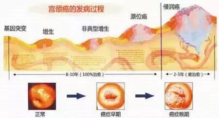 cin癌前病变,癌前病变cin二级癌症概率大不大