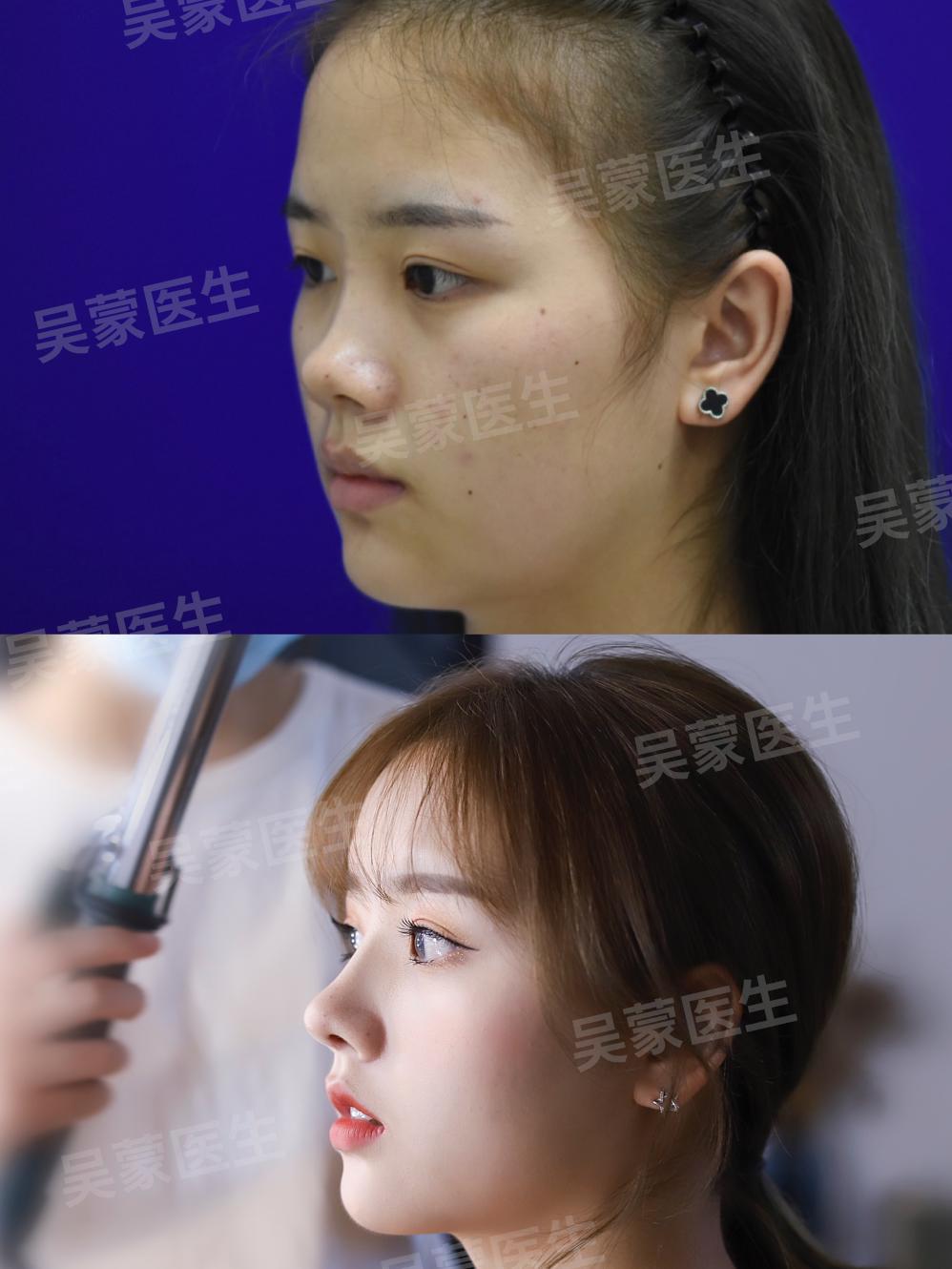 鞠婧祎鼻子整过吗,鞠婧祎的鼻子整过吗