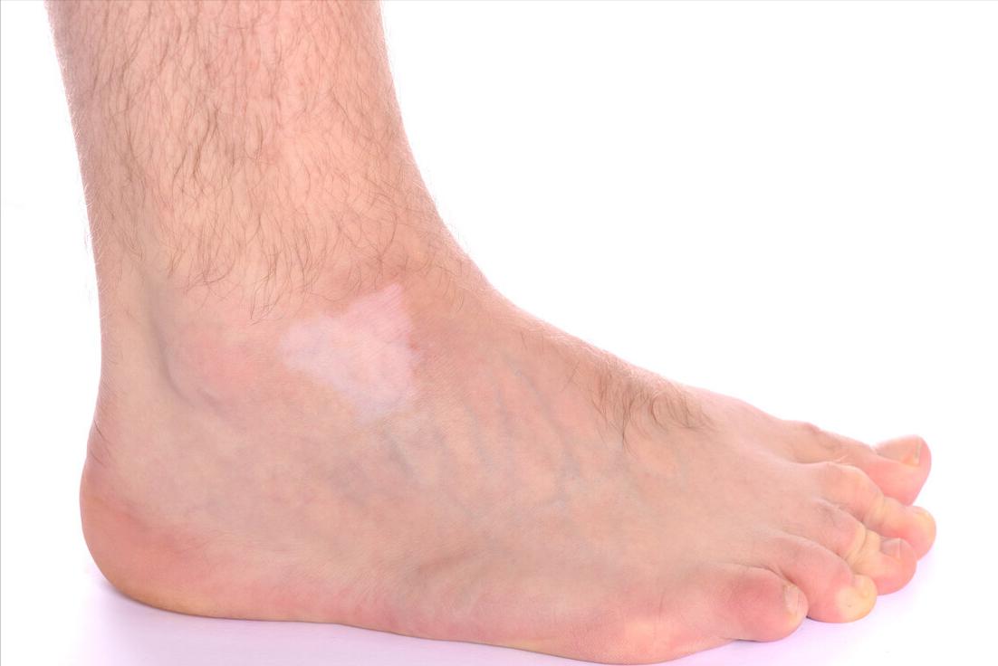 身上出现白斑是癌症吗,身上出现白斑都是白癜风吗