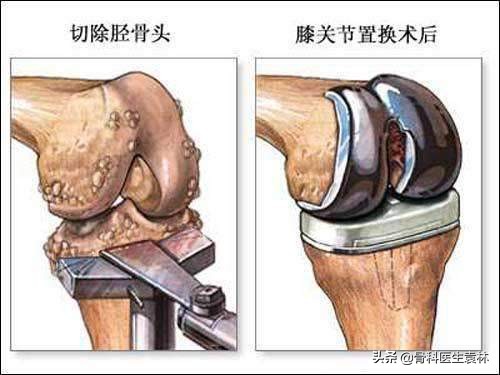 膝盖长骨刺药物治疗还是手术治疗,膝盖长骨刺怎么治疗能根除