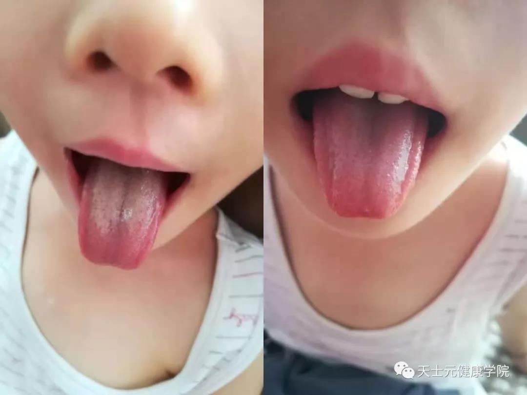 小孩腺样体肥大可以中药调理好吗,孩子腺样体肥大容易上火怎么调理