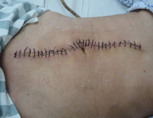 肿瘤切除取出,微创手术切除的肿瘤怎么取出体外