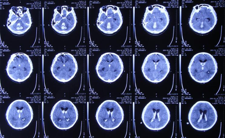 脑出血后脑积水会造成意识不清吗,脑出血后脑积水发高烧危险期多久