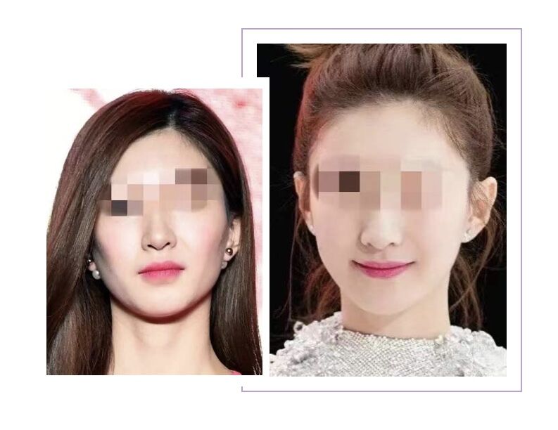 关于瘦脸的知识,关于瘦脸针