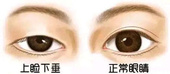 眼皮耷拉的厉害是怎么回事,眼睛眼皮往下耷拉肌无力怎么治