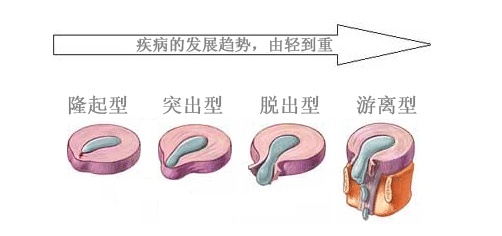 腰突腰痛怎么办最快缓解,腰突腰痛试试这九个动作