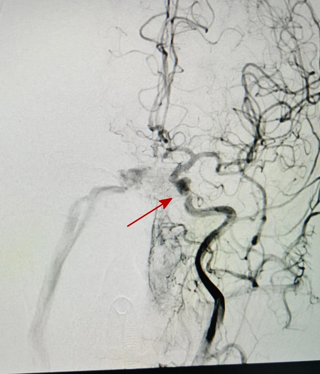 眼睛看东西重影是近视么,眼睛看东西重影是脑梗引起的吗
