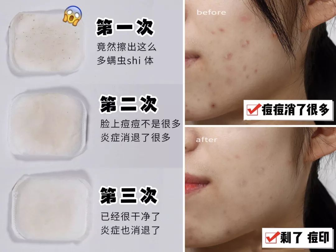 脸油痘痘多黑头用什么简单洗干净,清理黑头痘痘的最简单方法