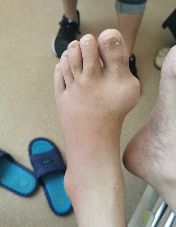 脚大拇外翻和痛风有什么区别,大脚趾痛风和拇外翻的区别