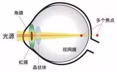 散光会引起色弱吗,散光会不会导致色弱