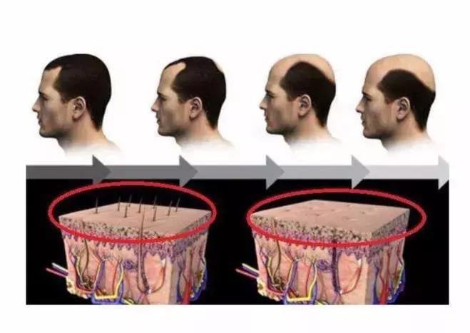 治疗脱发大部分都是骗人的吗,治脱发药有效吗
