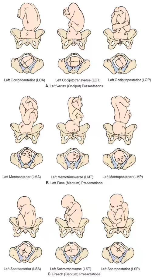 髋臼发育不良截骨的原理,髋臼截骨后会有长短腿吗