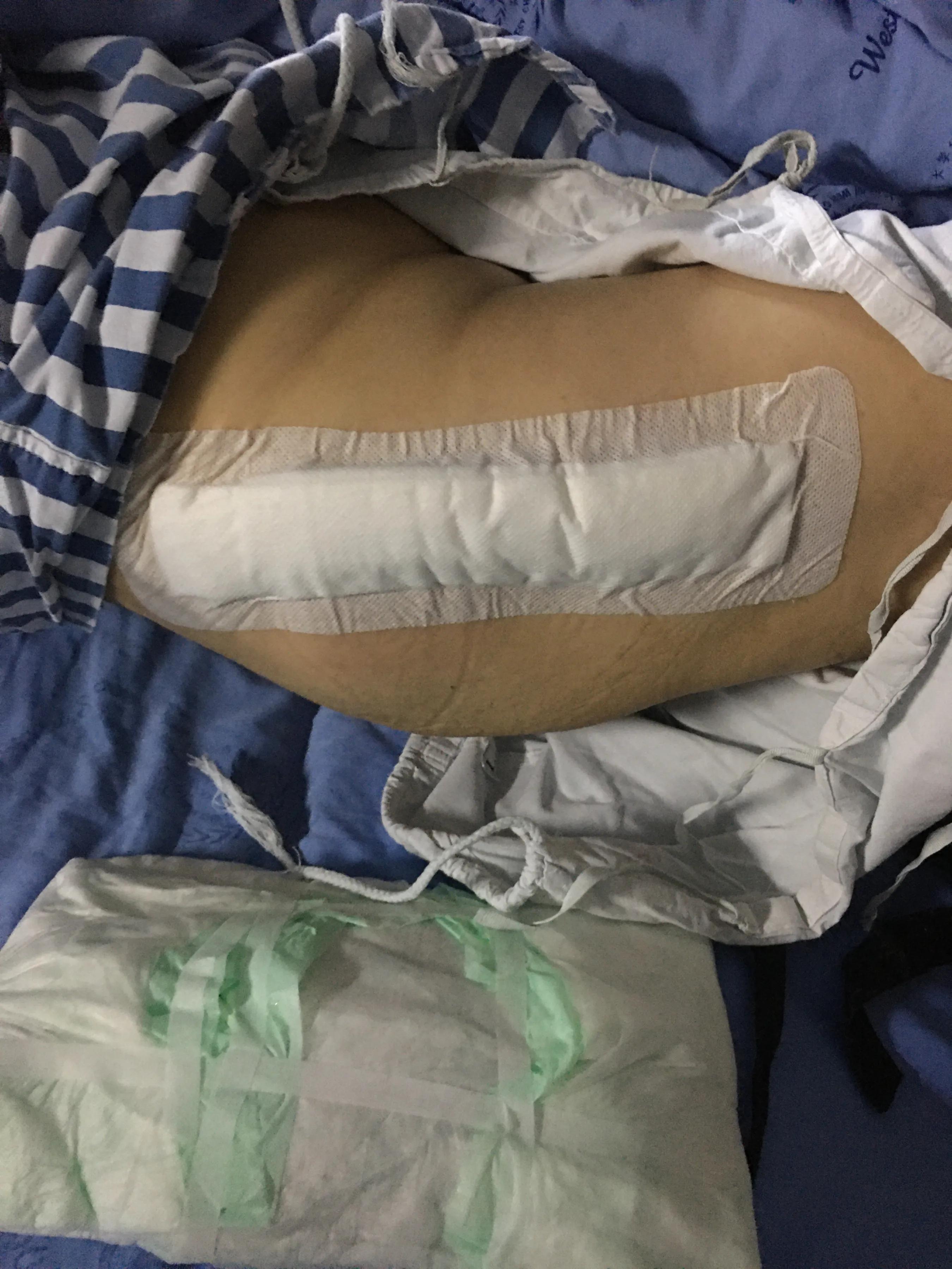 华西医院谈全髋关节置换寿命问题,华西髋关节置换术后本人真实感受