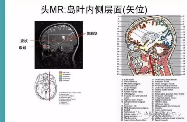 电子版头颅ct与mri断层解剖,头颅mri血管解剖与分段详解