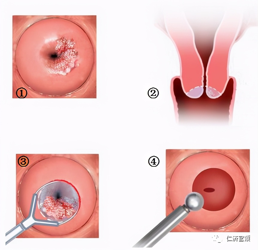 leep手术后遗症,锥切leep手术