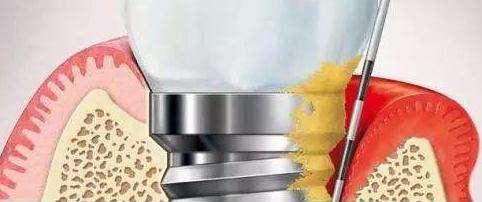 牙齿松动种植什么牙齿好,牙齿松动拔牙后镶和种植的区别