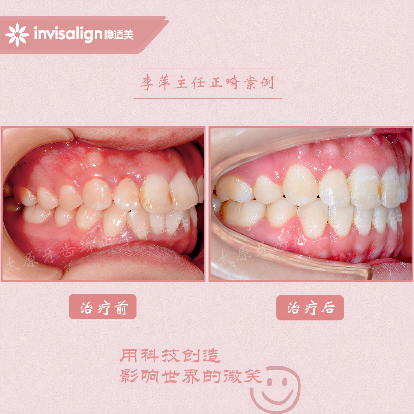 太原牙齿矫正拔牙拔六颗有危害吗,太原牙齿开合矫正