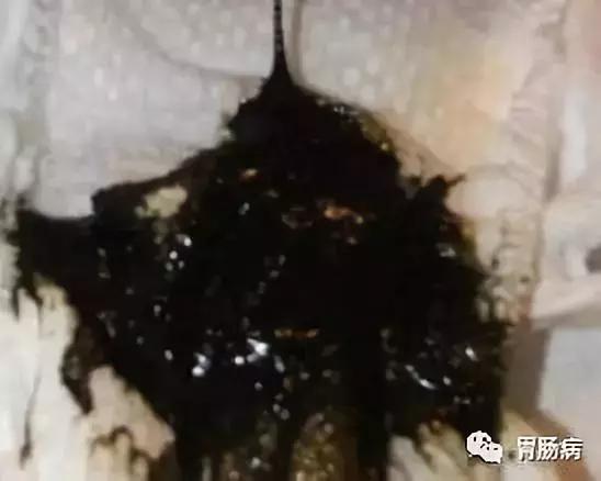 便血是直肠癌的早期吗,便血是直肠癌的前兆吗