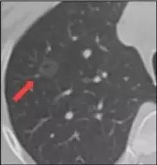 肺结节无任何症状中医治疗肺结节,体检查出肺结节莫慌中医有妙招
