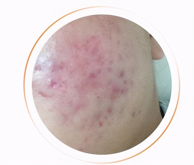 昆明祛除痘印痘坑,如何祛除痘印痘坑效果好