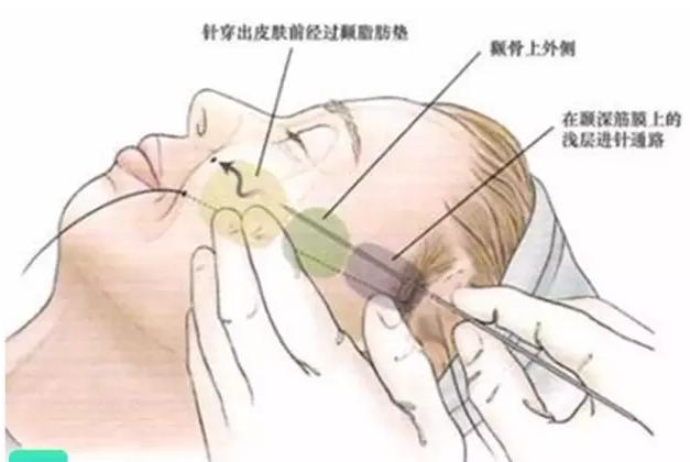 光子嫩肤脱毛仪的危害和禁忌,光子嫩肤注意事项文字