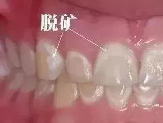 牙齿上有白斑是缺氟还是氟多了,儿童新长的牙有白斑黄斑会烂掉吗
