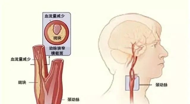 动脉硬化应注意什么怎么治疗,动脉硬化是怎么引起的要注意什么