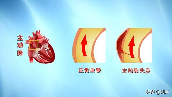 人体血管破裂还有救么,体内动脉血管破裂几级疼