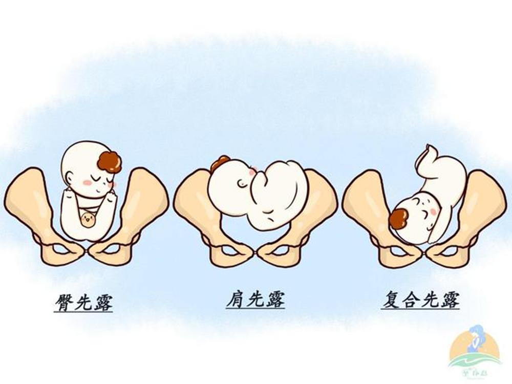 胎位不正的原因和注意事项,胎位不正最佳调整方法