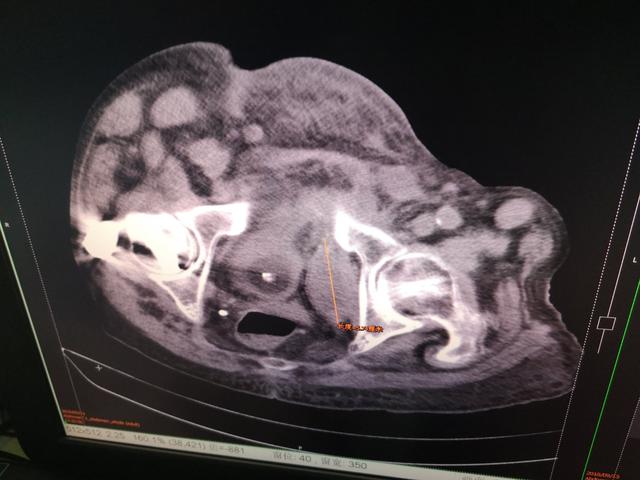 肝硬化腹水中药治好病例,肝硬化腹水中医辨证论治