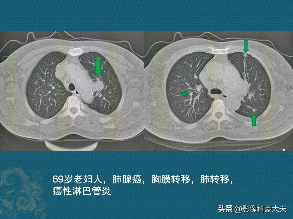 肺癌晚期的肿瘤有多大,肺癌晚期患者肿瘤一般是多大