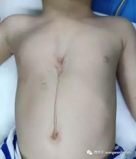 先心病开胸手术胸骨用什么缝合,心脏手术后胸骨后脓肿怎么处理