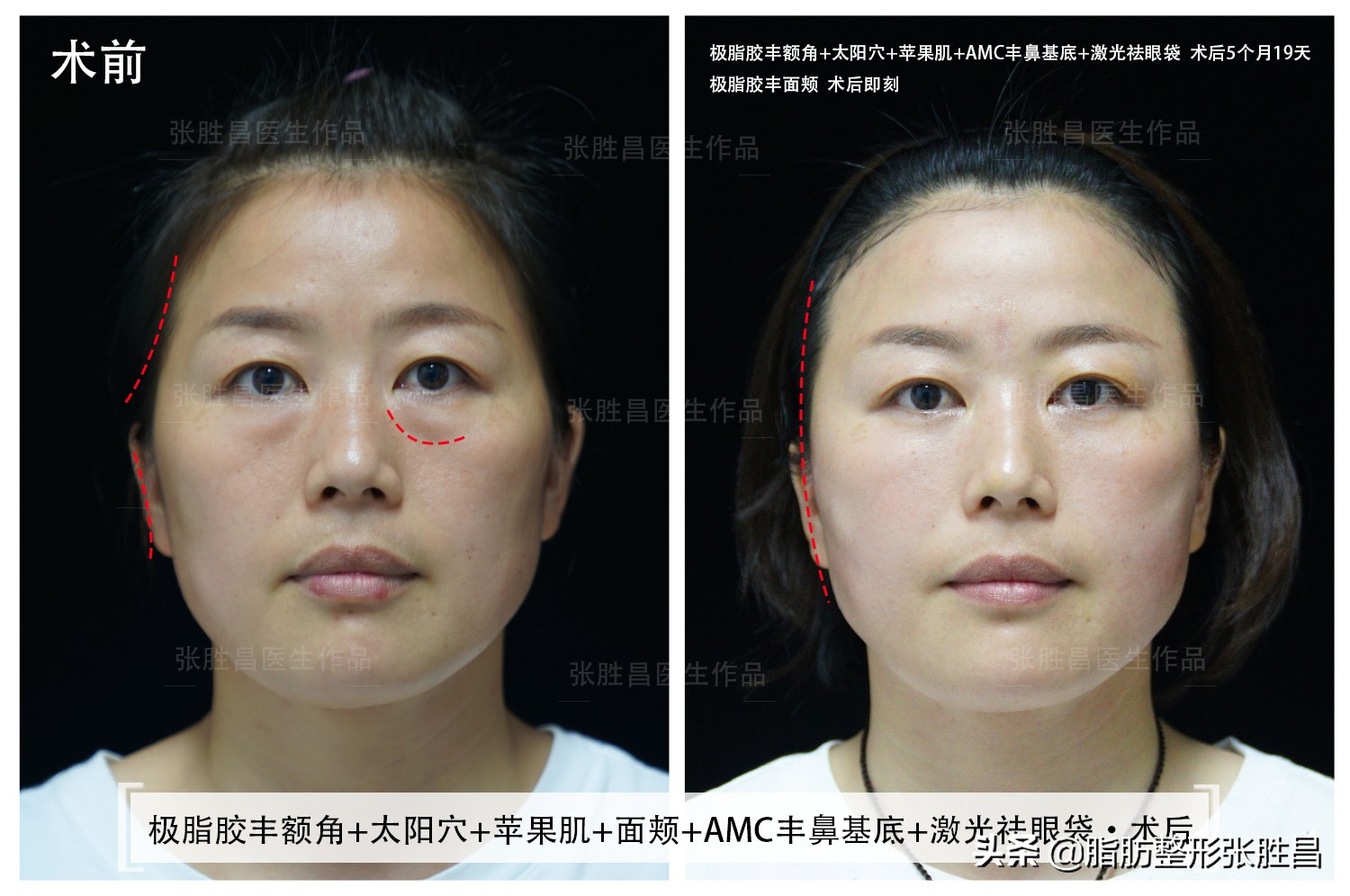 做脂肪填充面部以后变胖了,做脂肪面部填充会变美吗