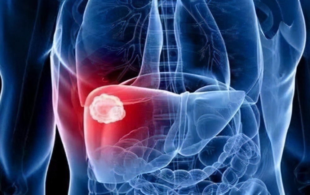 乙肝导致肝癌要不要吃抗乙肝药,吃了十几年抗病毒药为啥还得肝癌