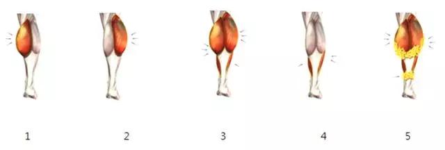 小腿粗壮弯曲不直是什么原因,小腿太粗是经常跑步的原因吗