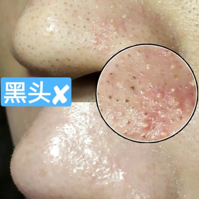 鼻子挤出黄米粒怎么解决,鼻子上有小洞能挤出很多东西
