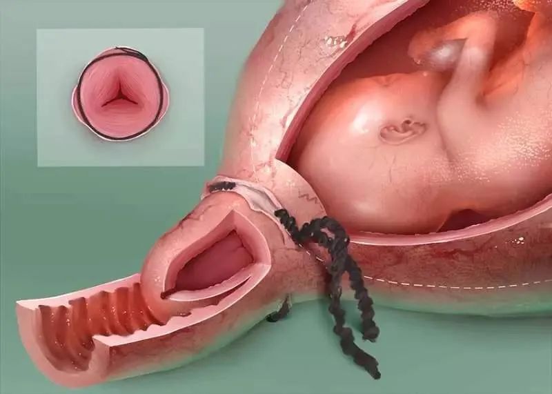 宫颈环扎后要卧床多久,环扎手术后要卧床到几周